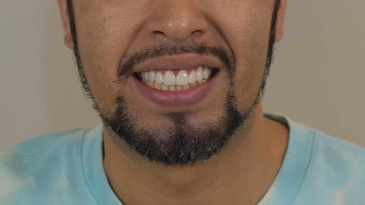 Resultado natural de diseño de sonrisa en Morán Dental Clinic