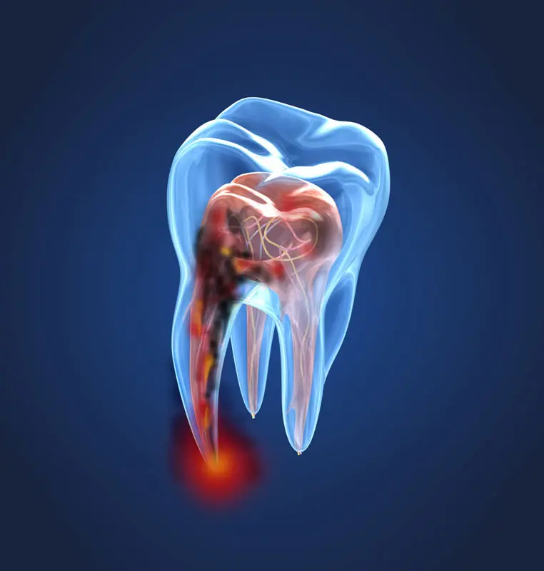 Endodoncia y Restauraciones
