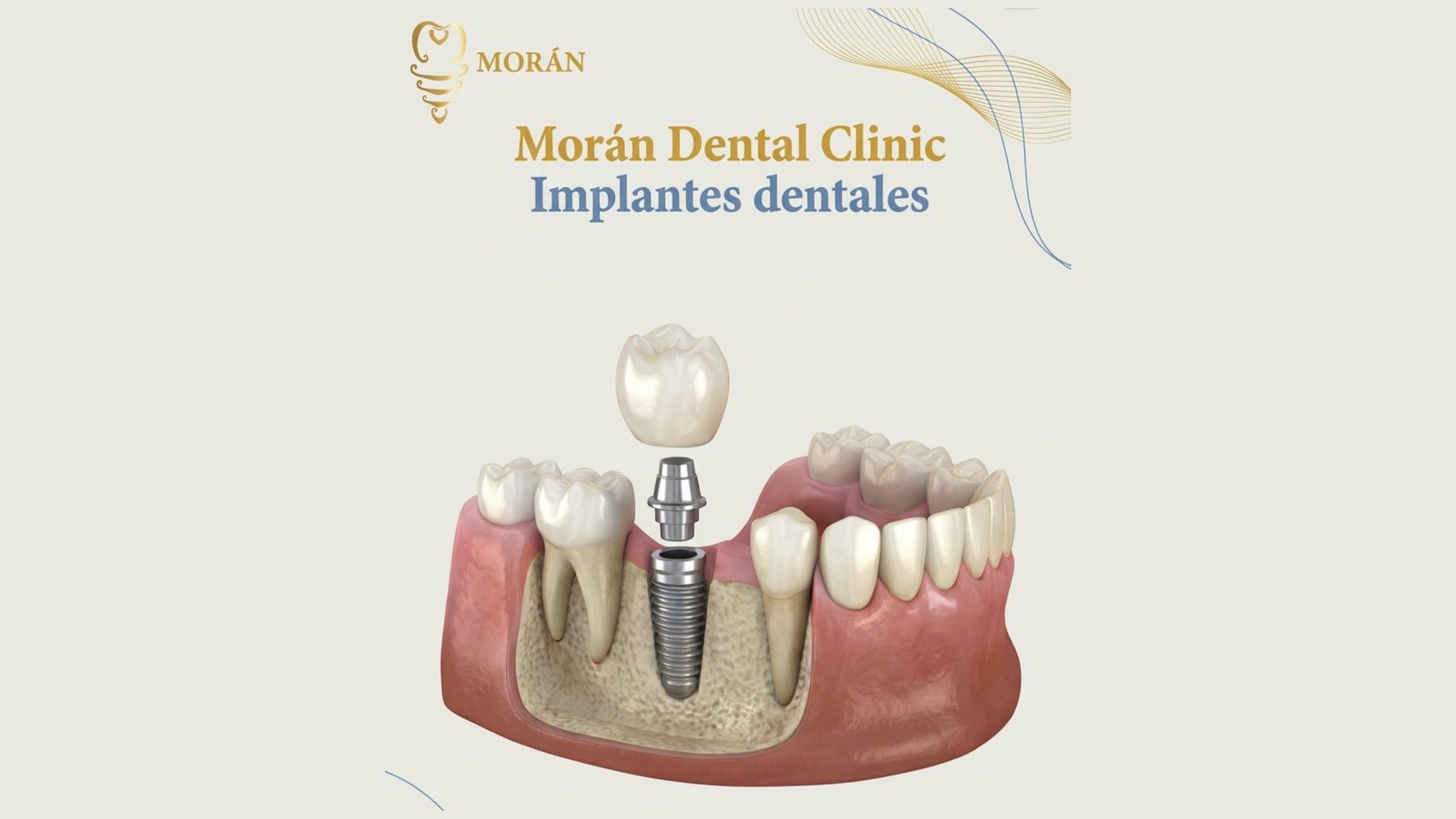 Diagrama de un implante dental en Morán Dental Clinic
