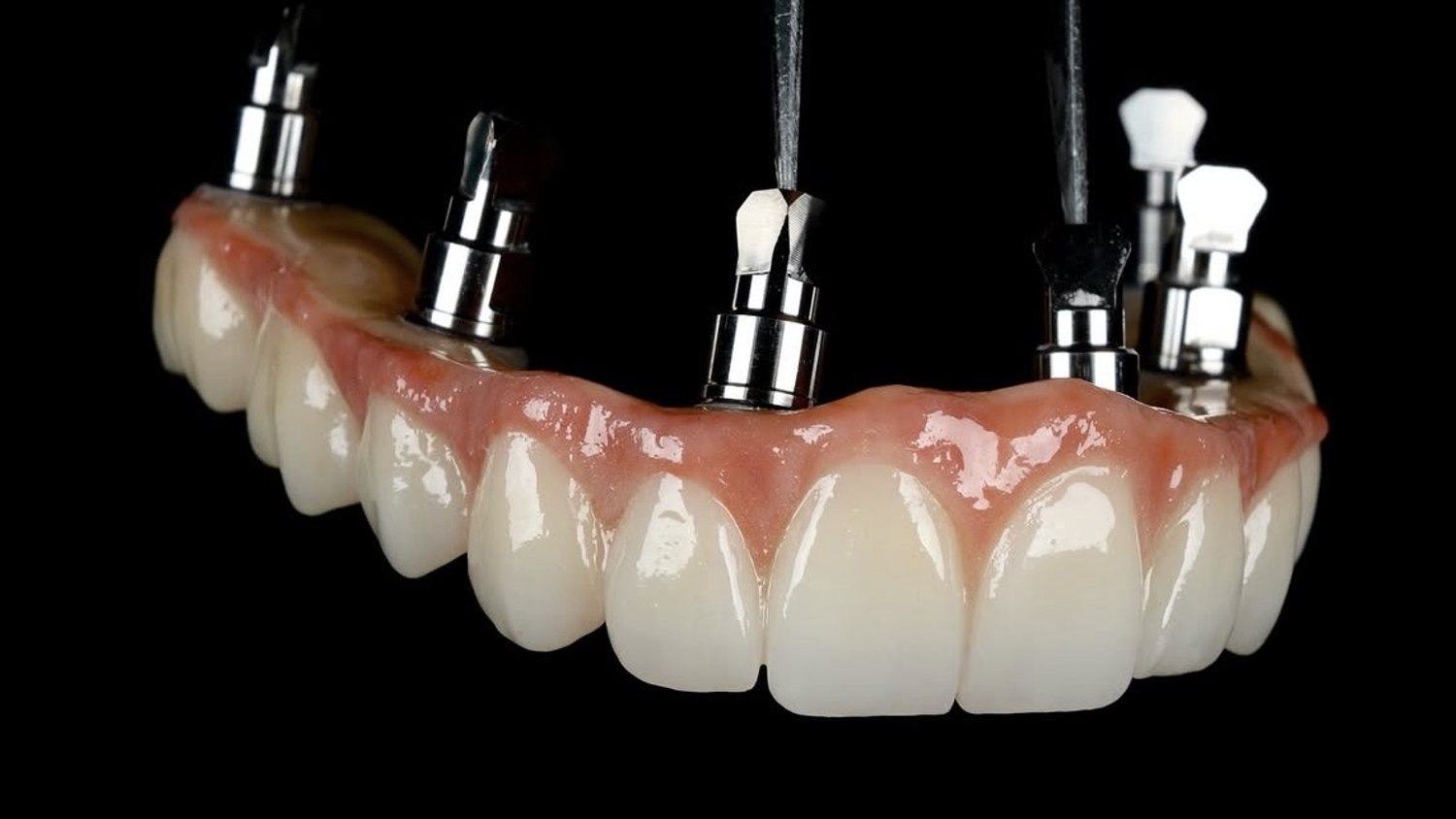 Rehabilitación oral sobre implantes en Morán Dental Clinic