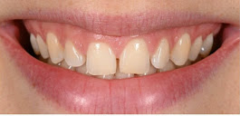 Diseño de Sonrisa III Antes