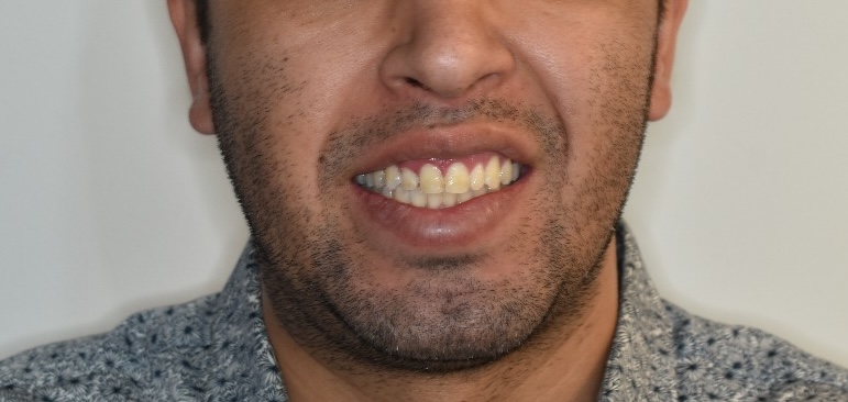 Caso 1 Antes