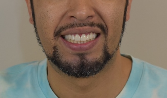 Diseño de Sonrisa Digital