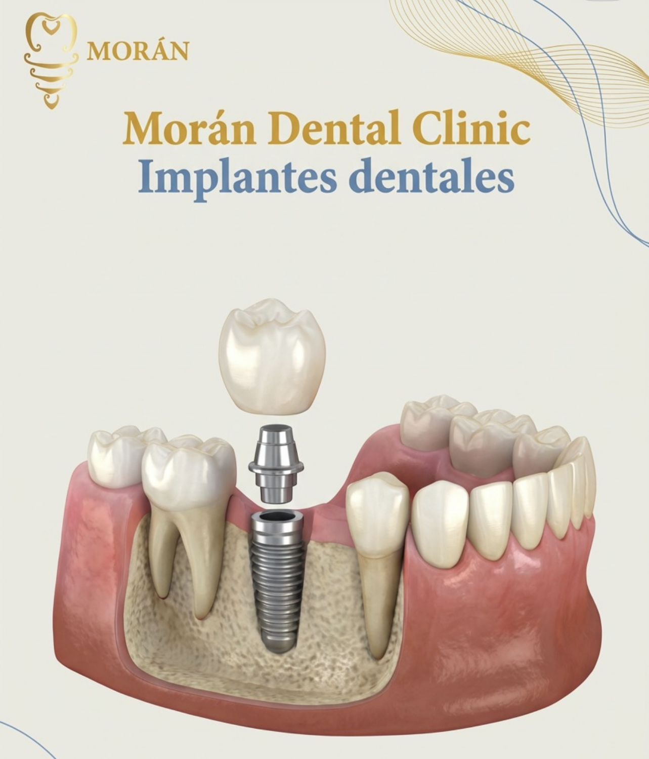 Implantes Dentales Premium
