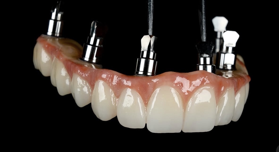 Prótesis y Rehabilitación Oral